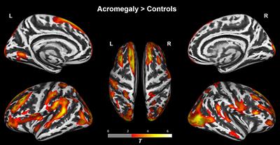 In Vivo Characterization of Cortical and White Matter Microstructural Pathology in Growth Hormone-Secreting Pituitary Adenoma